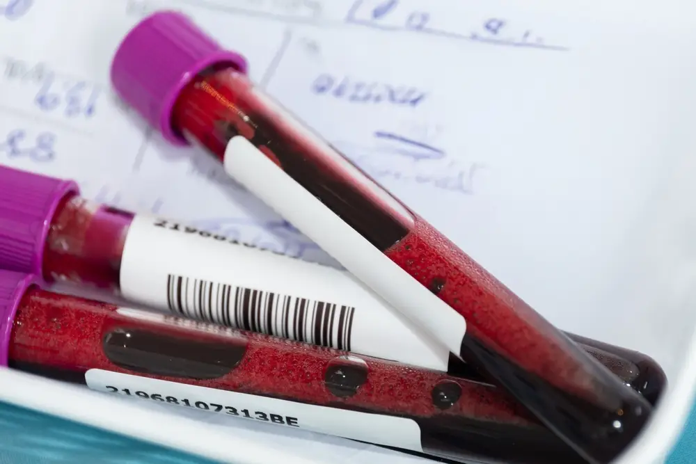 Ce analize arată dacă diabetul ți-a afectat rinichii - Corp sănătos