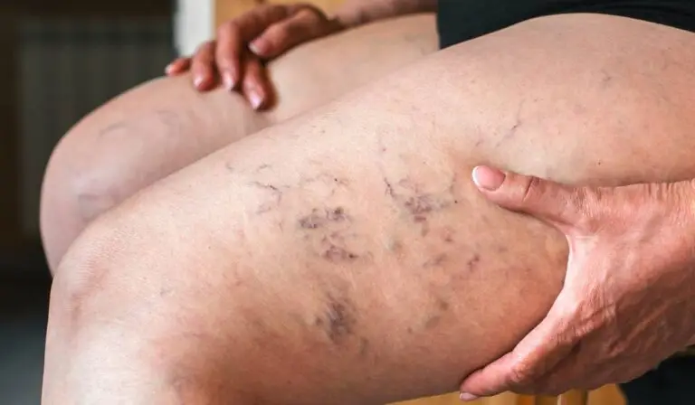 Ulcerele venoase: semnele pe care nu trebuie să le ignori