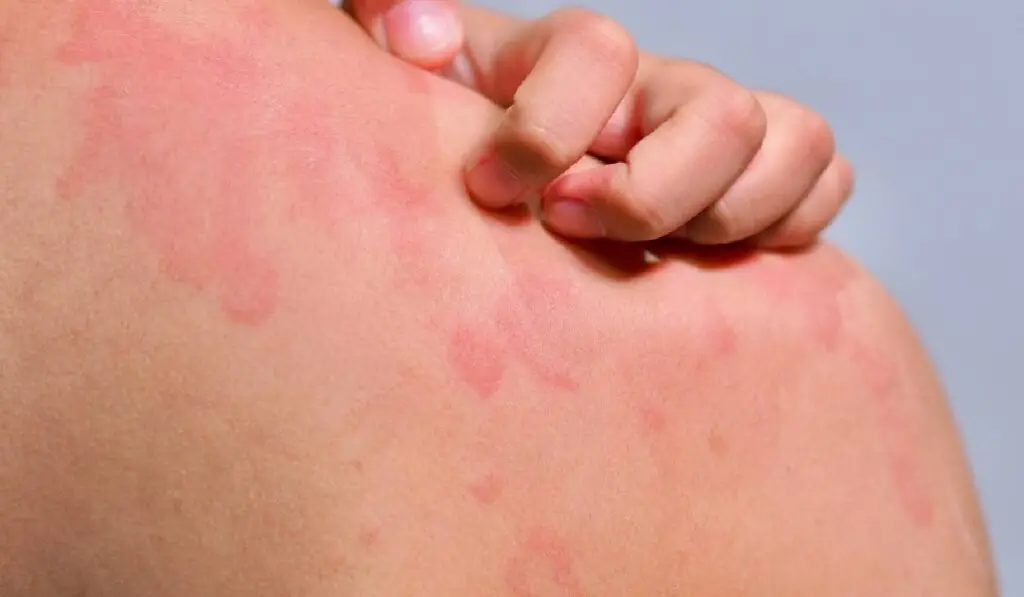 Urticaria cronică spontană: ce trebuie să știi despre ea - Corp sănătos