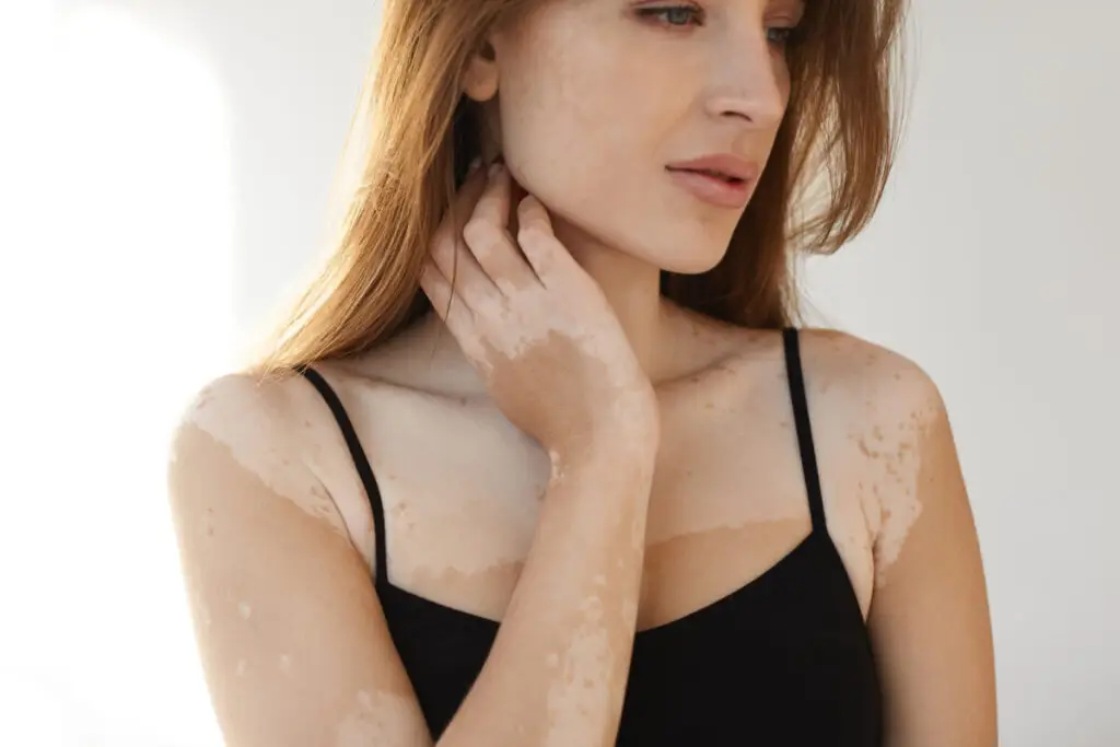 Vitiligo: ce trebuie să știi despre această afecțiune - Corp sănătos
