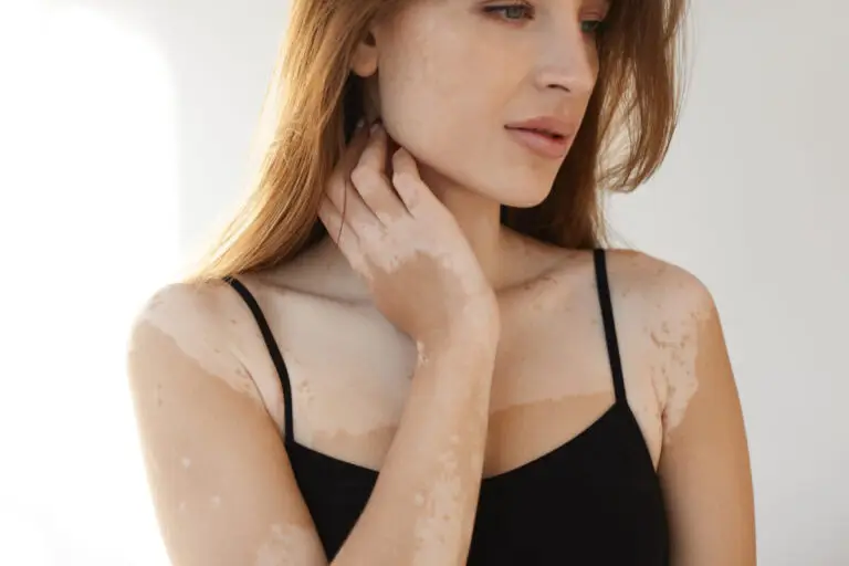 Vitiligo: ce trebuie să știi despre această afecțiune