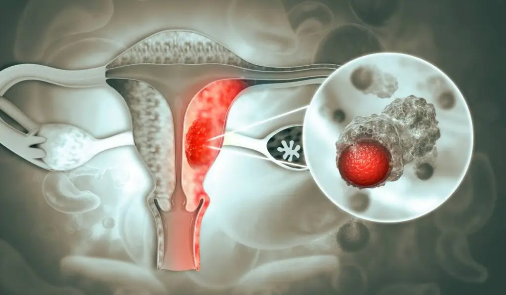Cancerul ovarian: simptome pe care nicio femeie nu trebuie să le ignore - Corp sănătos
