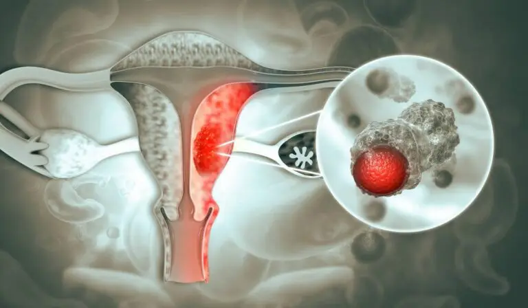 Cancerul ovarian: simptome pe care nicio femeie nu trebuie să le ignore