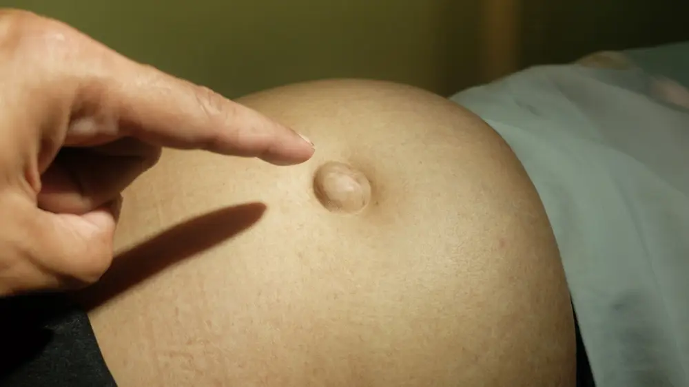 Umflătura de la buric care poate ascunde o hernie - Corp sănătos