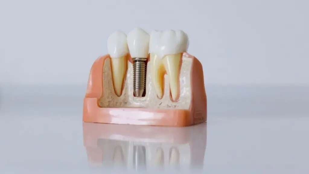 Osteointegrarea: de ce implantul dentar are nevoie de timp - Corp sănătos