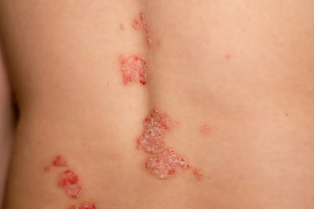 Remedii naturale pentru psoriazis: ce funcționează cu adevărat? - Corp sănătos