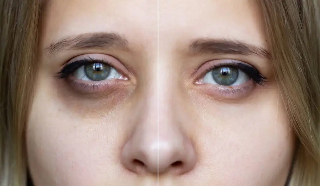 Ferritin Face, trendul TikTok despre fier: ce e adevărat? - Corp sănătos